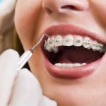 Best Adult Braces Options | Comprehensive Guide IMG_4932